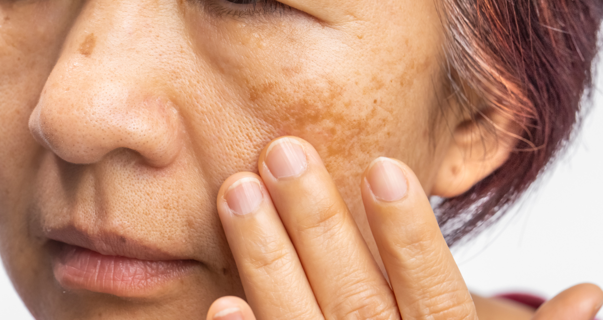 איזה טיפ מיקרונידלינג מתאים לפיגמנטציה