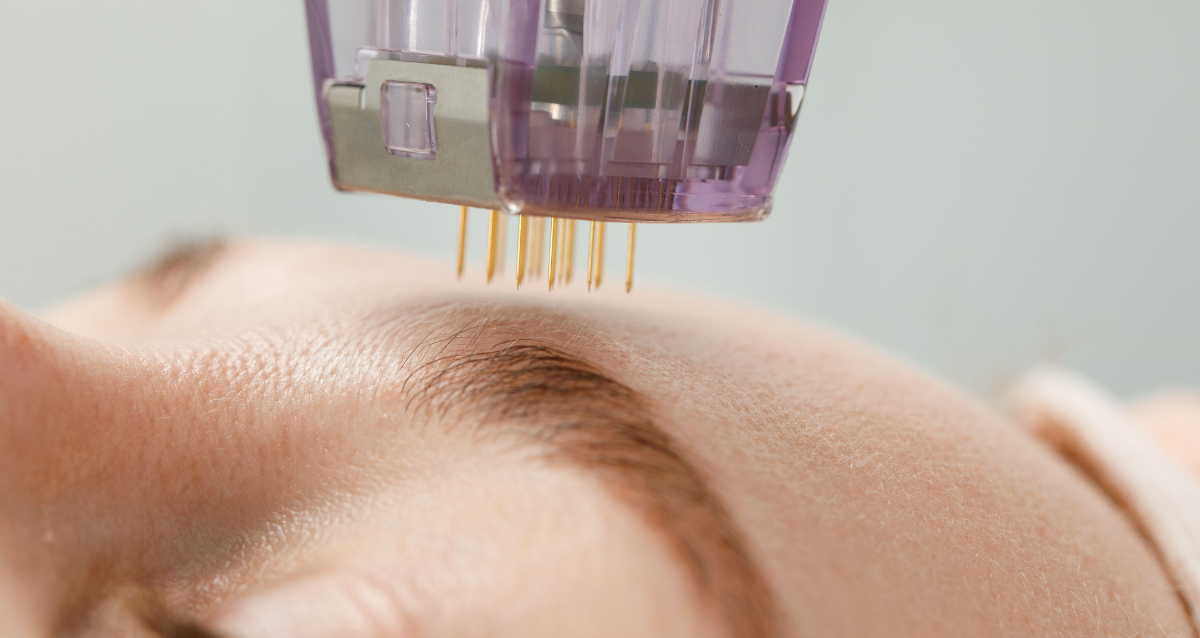 ההבדלים בין Microneedling RF ל־Fractional RF